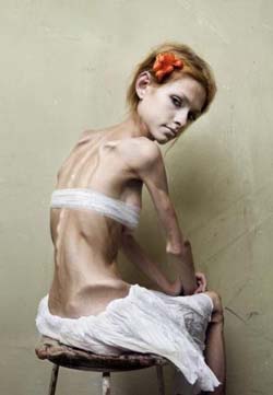 anorexia3